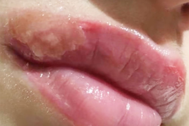 Nổi mụn nước li ti