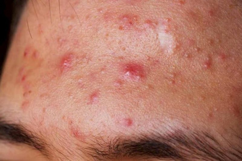 Tình trạng mụn ẩn không được điều trị có thể phát triển thành mụn viêm