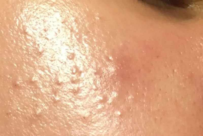 Da dầu là nguyên nhân dẫn đến mụn ẩn