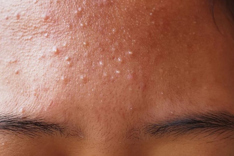 Mụn ẩn dưới da thường không nhìn thấy rõ nhưng có thể cảm nhận bằng tay