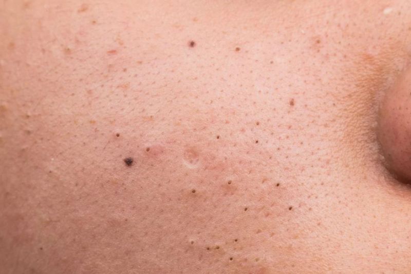Mụn đầu đen gây thâm trên da