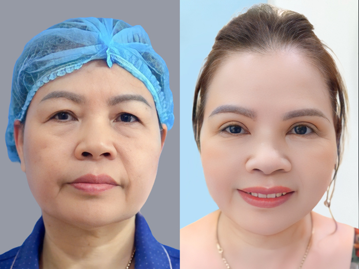 Nâng cung mày tăng thẩm mỹ cho gương mặt