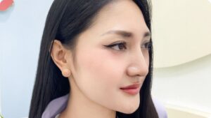 Nâng mũi là gì? Hiểu đúng về các phương pháp cải thiện dáng mũi