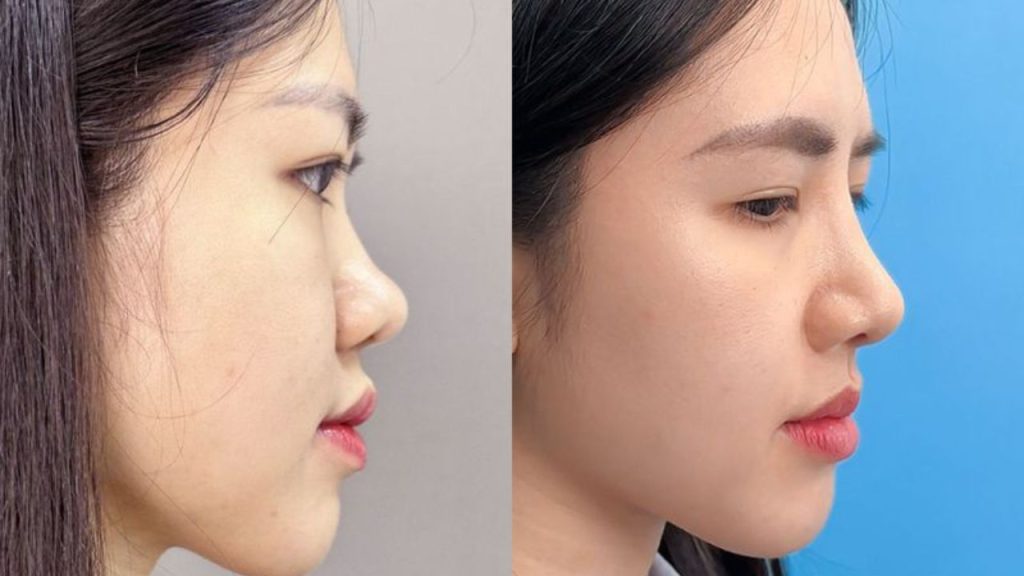 Nâng mũi cấu trúc Idol – Mũi siêu nhẹ tướng kiêu kỳ, trào lưu của các Idol Kpop