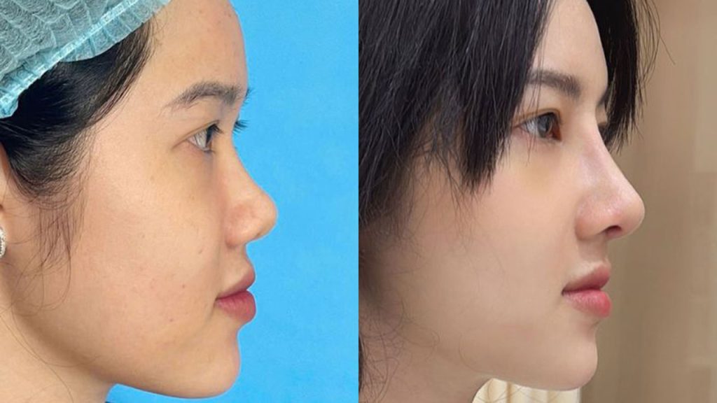 Nâng mũi 6D không đau Surgiform là gì? Tìm hiểu từ A-Z