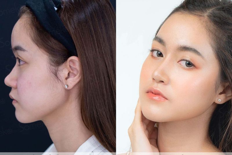 Cận cảnh dáng mũi sau nâng, sống mũi cao, đầu mũi gọn và cân đối