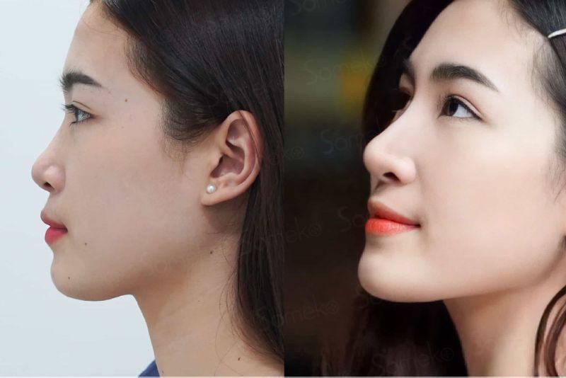 Hình ảnh trước – sau nâng mũi bán cấu trúc