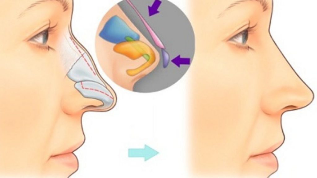 Nâng mũi bán cấu trúc là gì? Ưu nhược điểm và đối tượng phù hợp