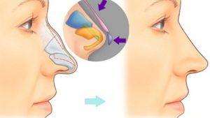 Nâng mũi bán cấu trúc là gì? Ưu nhược điểm và đối tượng phù hợp