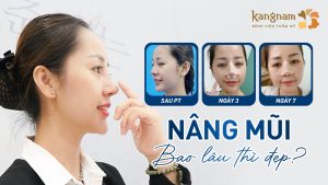 Nâng mũi bao lâu thì đẹp? Thời gian hồi phục & dấu hiệu ổn định