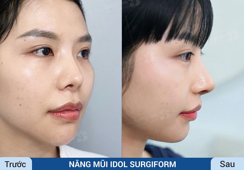 Nâng mũi bằng công nghệ hiện đại sẽ giúp dáng mũi nhanh vào form, đẹp tự nhiên