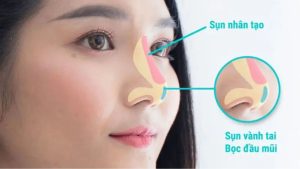 Nâng mũi bọc sụn là gì? Kiến tạo dáng mũi cao đẹp, không lo lộ sống