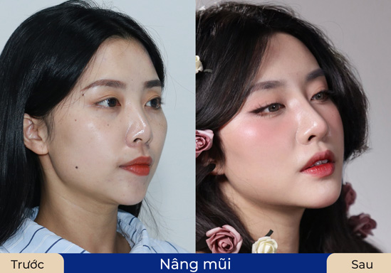 Form mũi cao và đẹp sau khi nâng