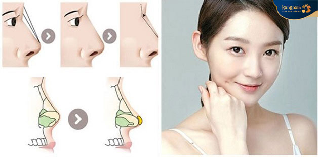 Mũi sau nâng sau 20 - 30 ngày sẽ nên form đẹp tự nhiên