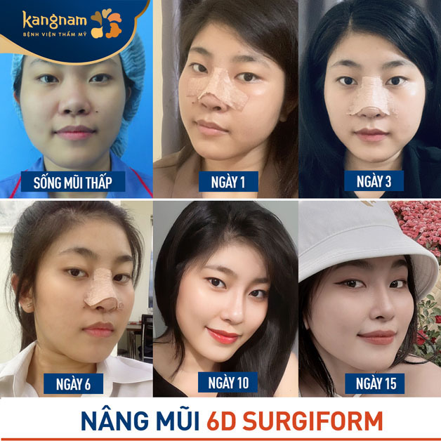 Nâng mũi 6D Surgiform