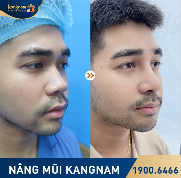 Anh Minh sở hữu dáng mũi cao thẳng sau khi nâng mũi