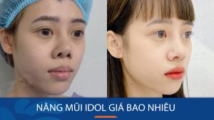 Nâng mũi Idol giá bao nhiêu? Bảng giá mới nhất