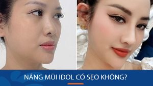 Nâng mũi Idol có sẹo không? Giải đáp thắc mắc từ chuyên gia