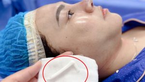 Nâng mũi cấu trúc Idol có tháo ra được không? Giải đáp từ chuyên gia