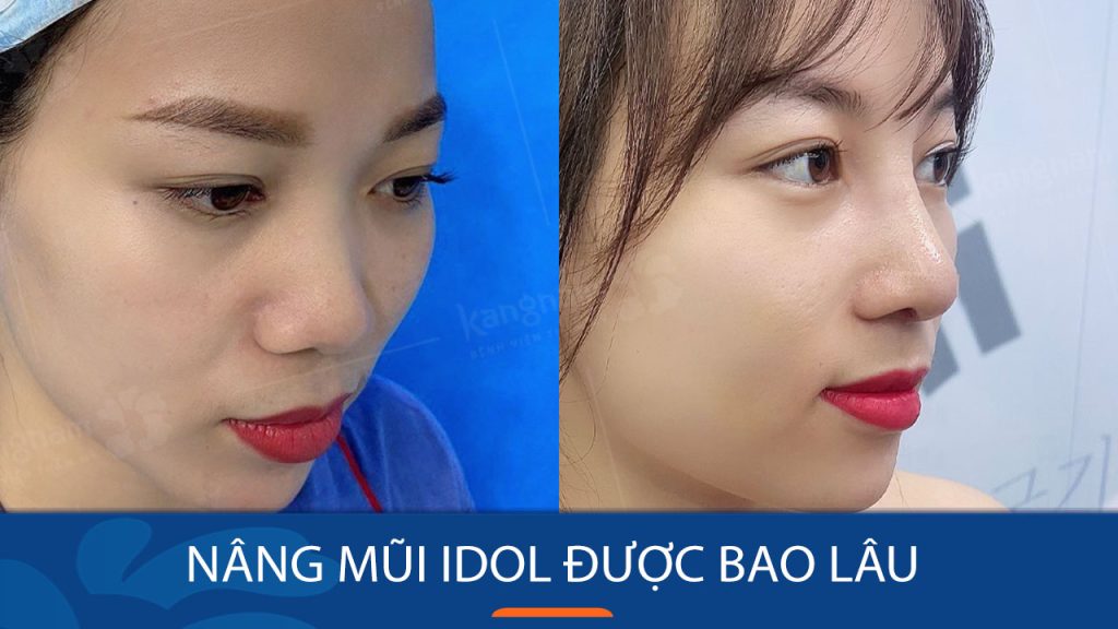Nâng mũi Idol bao lâu thì đẹp? Bí quyết sở hữu dáng mũi thần tượng