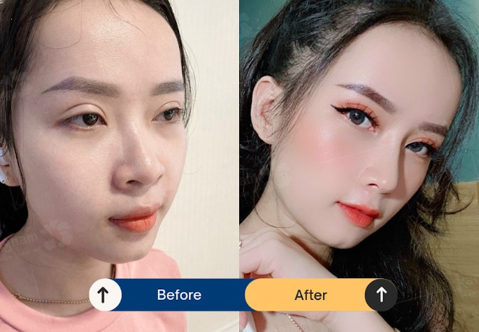 Hình ảnh khách hàng sau khi được bác sĩ Henry nâng mũi