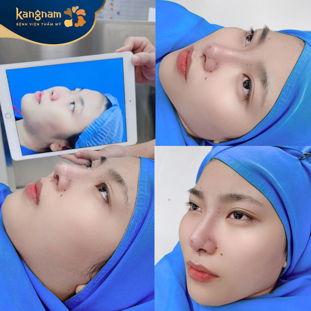 Mũi vừa làm xong, ít sưng, không tụ dịch