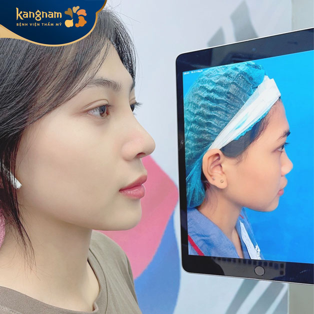 Cắt chỉ nâng mũi 6D sau 5 ngày