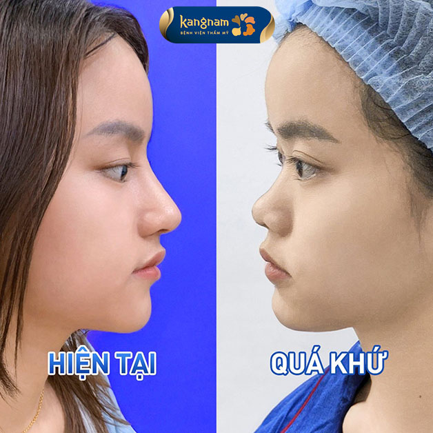 Nâng mũi là tiểu phẫu an toàn, thời gian thực hiện nhanh chóng