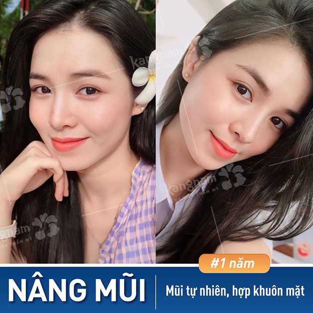 Dáng mũi L Line hài hòa với khuôn mặt