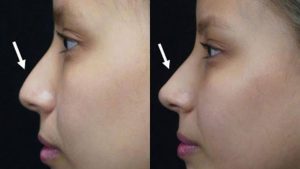 Hậu quả của nâng mũi khi về già: Sự thật không ai tiết lộ