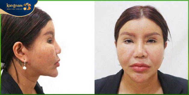 Mũi thay đổi về hình dáng, độ đàn hồi khi về già