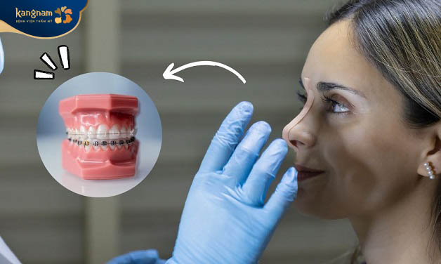 Hoàn toàn có thể niềng răng sau nâng mũi