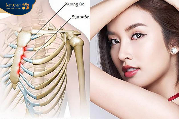 Nâng mũi bằng sụn sườn sử dụng sụn sườn được lấy từ cơ thể của chính người thực hiện