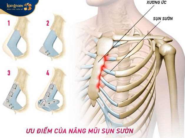 Nâng mũi sụn sườn cải thiện được hình dáng mũi, không gây đào thải, an toàn và tương thích với cơ thể
