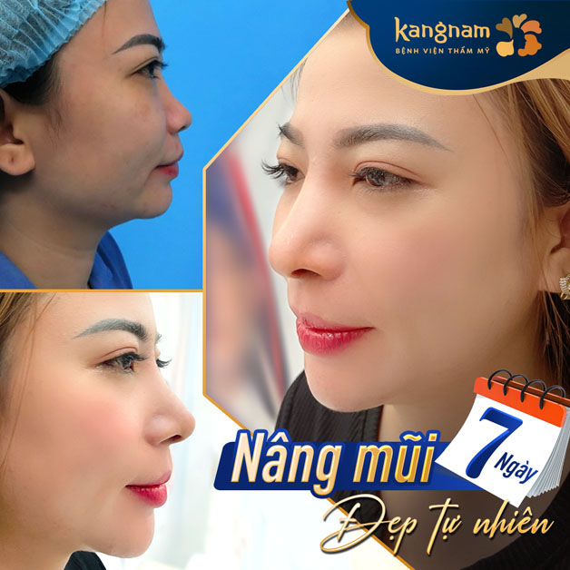 Thần thái sang chảnh, tự nhiên sau khi nâng mũi
