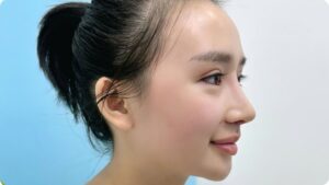 Hơn 20.000 ca phẫu thuật nâng mũi thành công tại BV Kangnam