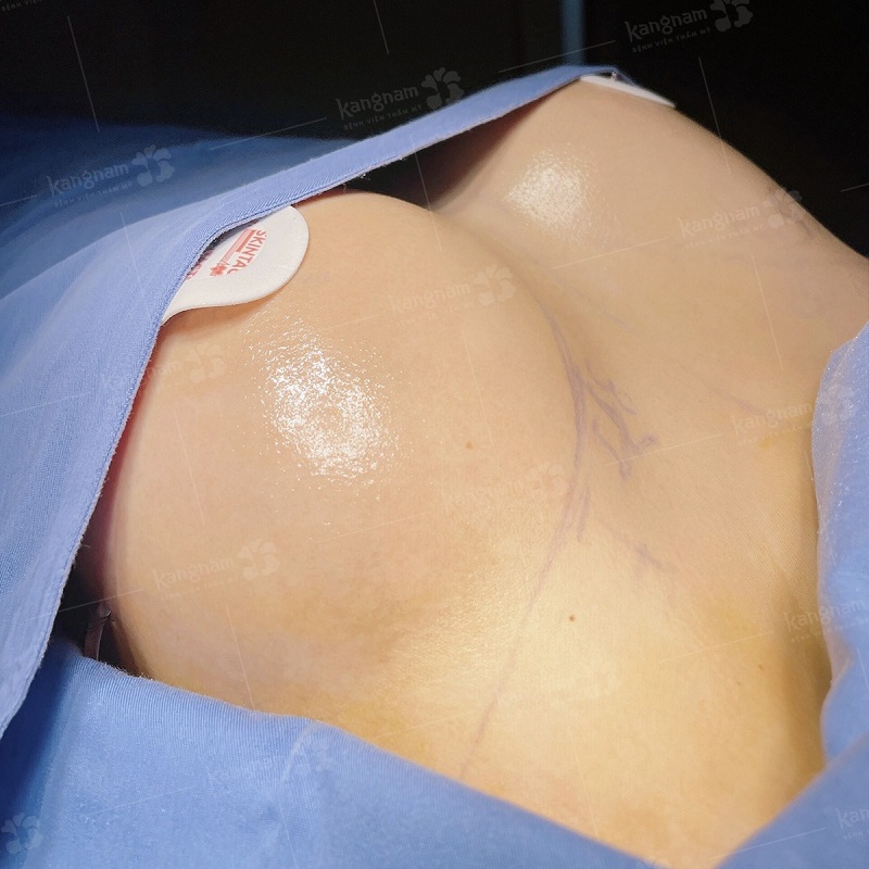 Sau nâng ngực chị em chỉ có cảm giác hơi châm chích, tê bì ở vòng 1