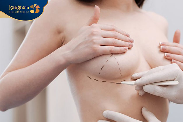 nâng ngực qua đường chân ngực có thể được coi là một lựa chọn tốt cho nhiều người