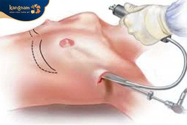 nâng ngực đường nách là một kỹ thuật thẩm mỹ tiên tiến