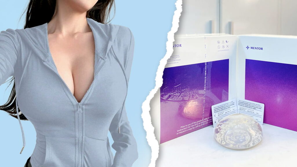 Nên chọn túi ngực Mentor hay Nano Chip? Giải đáp thắc mắc từ chuyên gia