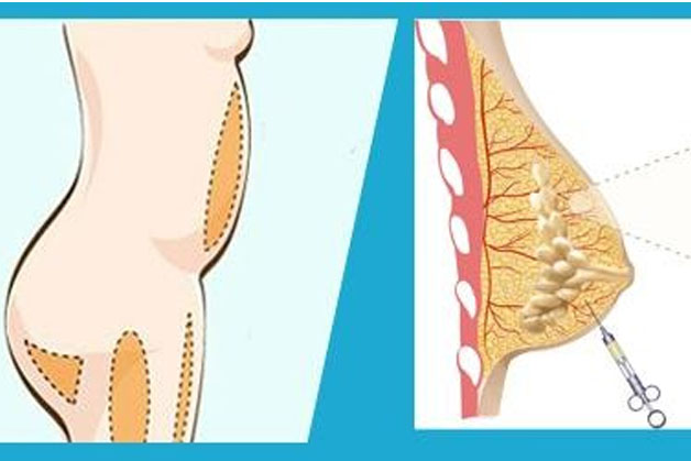 Nâng ngực bằng cấy mỡ tự thân sử dụng chính lượng mỡ dư thừa trên cơ thể để bơm vào vùng ngực