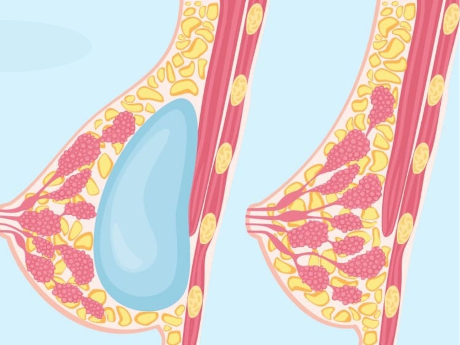 Ảnh minh họa cho thấy túi ngực nằm tách biệt với các cơ quan nội tạng