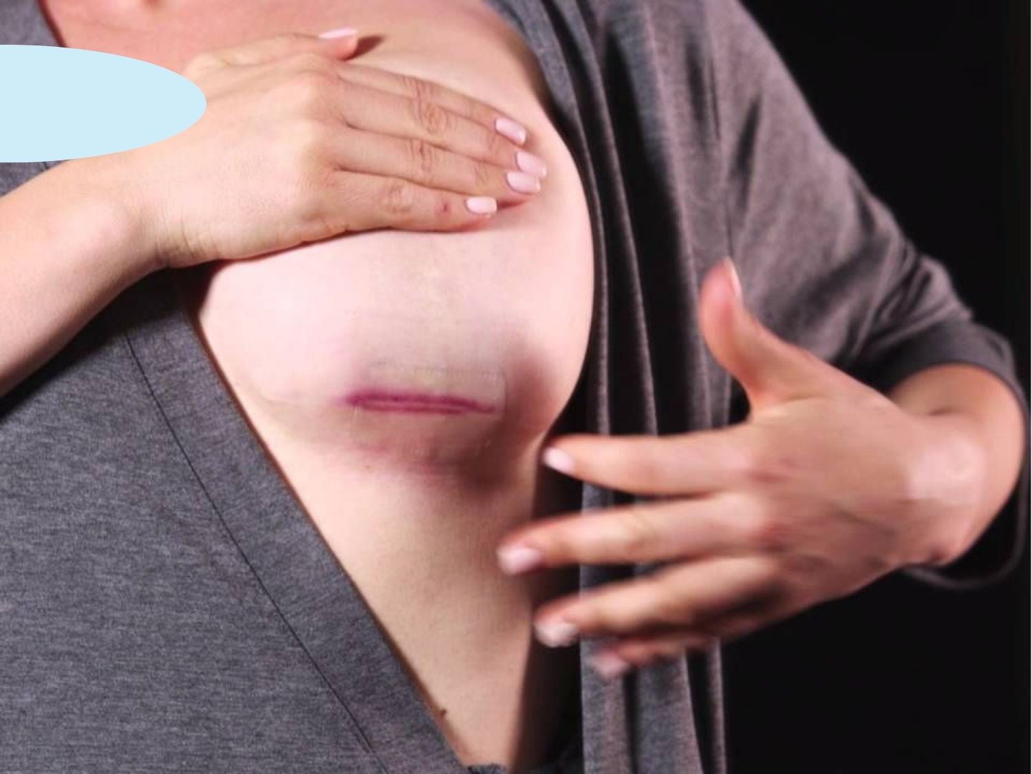 ảnh minh họa biểu hiện bất thường sau nâng ngực để khách hàng dễ đối chiếu