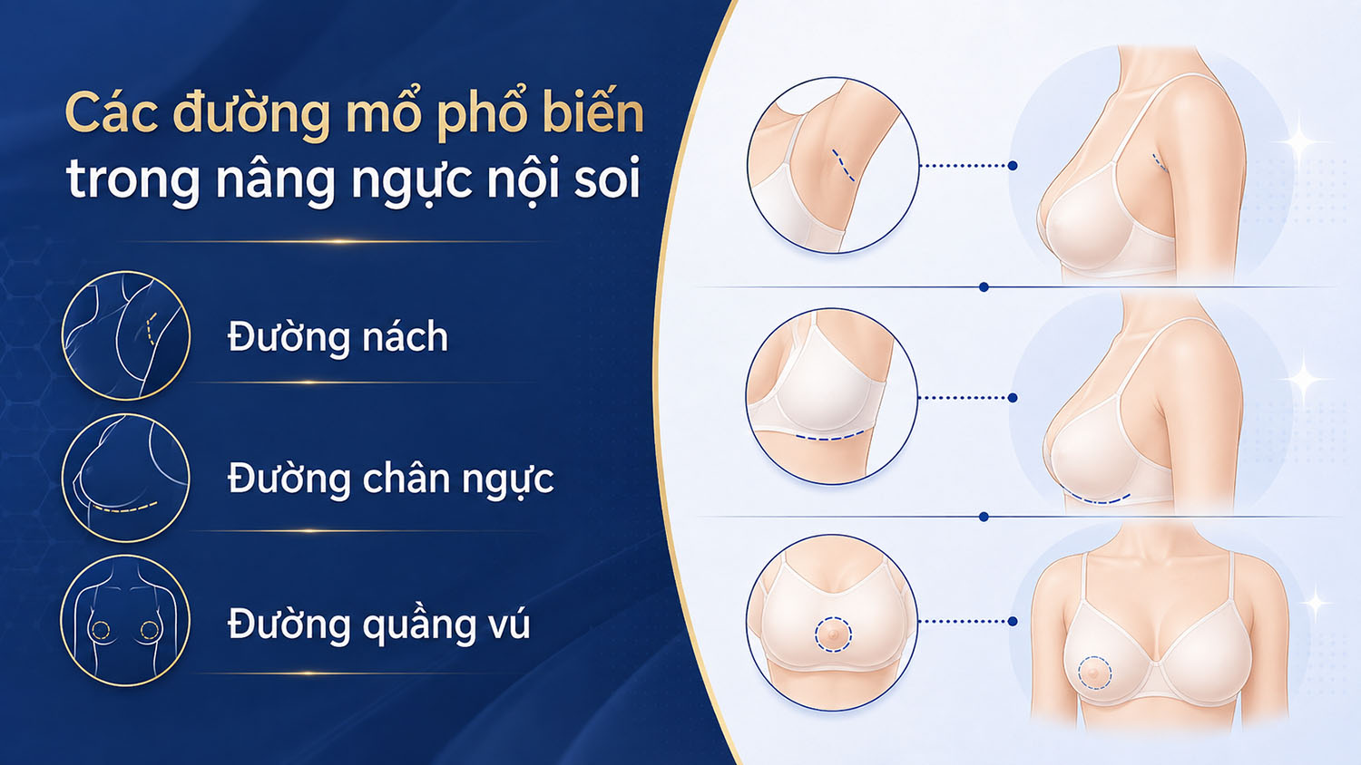 ảnh mô tả Các đường mổ phổ biến trong nâng ngực nội soi