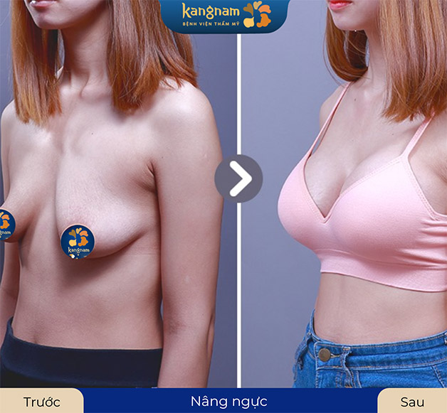 Nâng ngực chảy xệ bằng cách đặt túi ngực