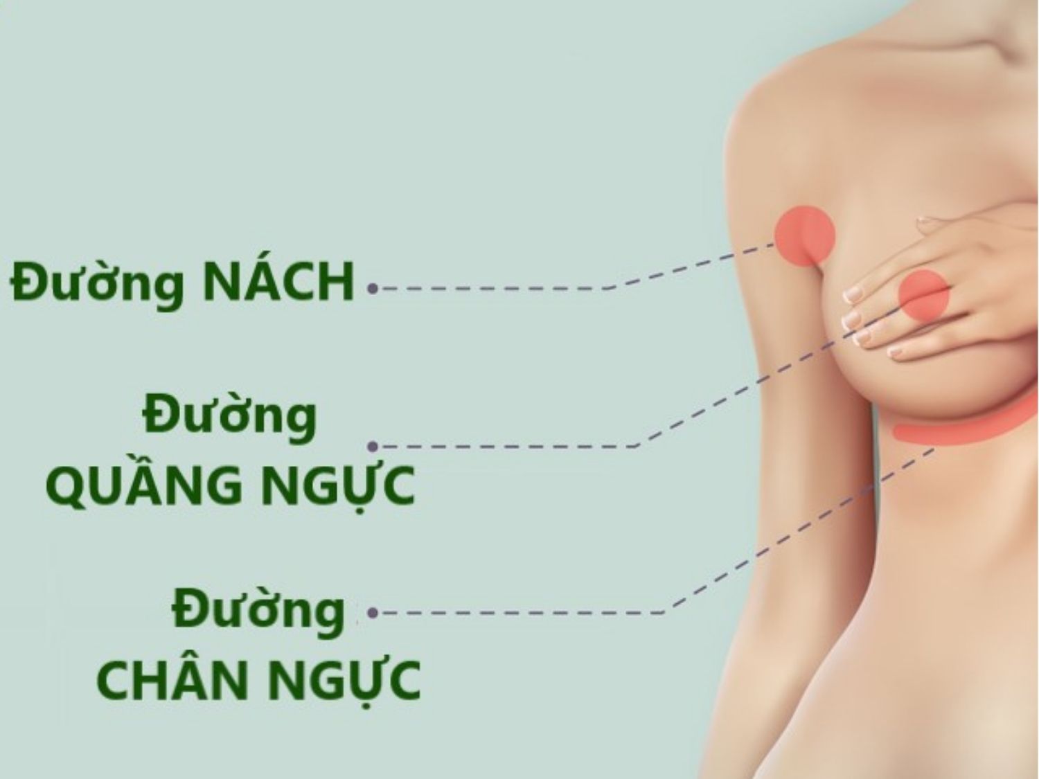 mô tả rõ các đường rạch nâng ngực có thể thực hiện, đây là 3 đường rạch phổ biến
