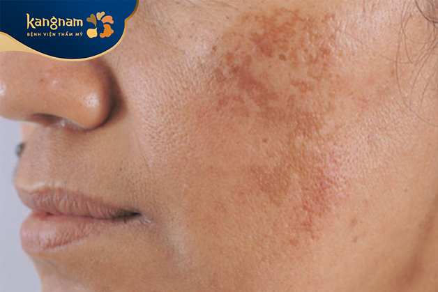 Yếu tố di truyền có thể góp phần tăng khả năng xuất hiện nám mảng