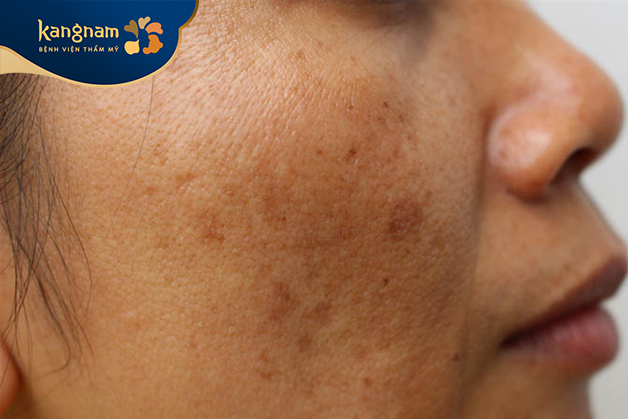 Diện tích mảng nám dao động từ 2-4cm