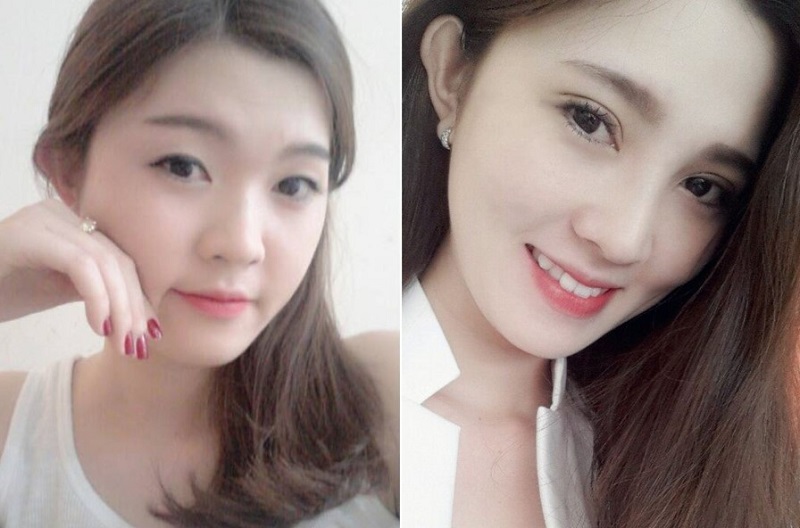 Nhấn mí tại địa chỉ thẩm mỹ uy tín sẽ giúp đảm bảo hiệu quả và an toàn