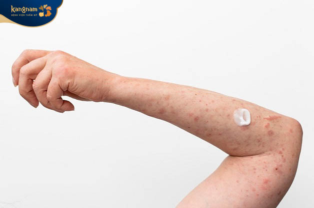 Tăng tiết bã nhờn gây nổi mụn ở tay